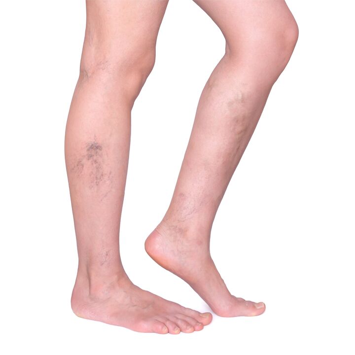 Tips for Neoveris - swollen, crooked veins in the legs