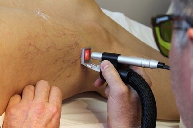 Laser treatment of varicose veins of lower limbs